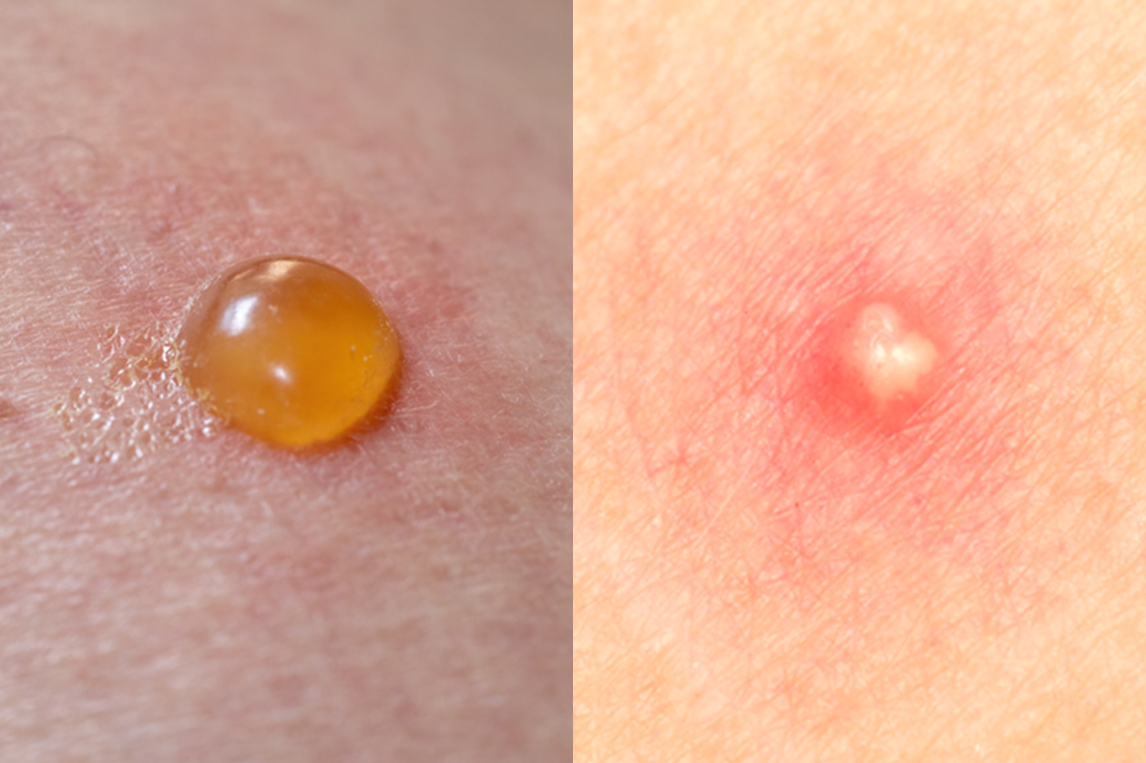How To Identify Common Bug Bites How To Identify Common Bug Bites