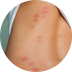 Red Itchy Welts